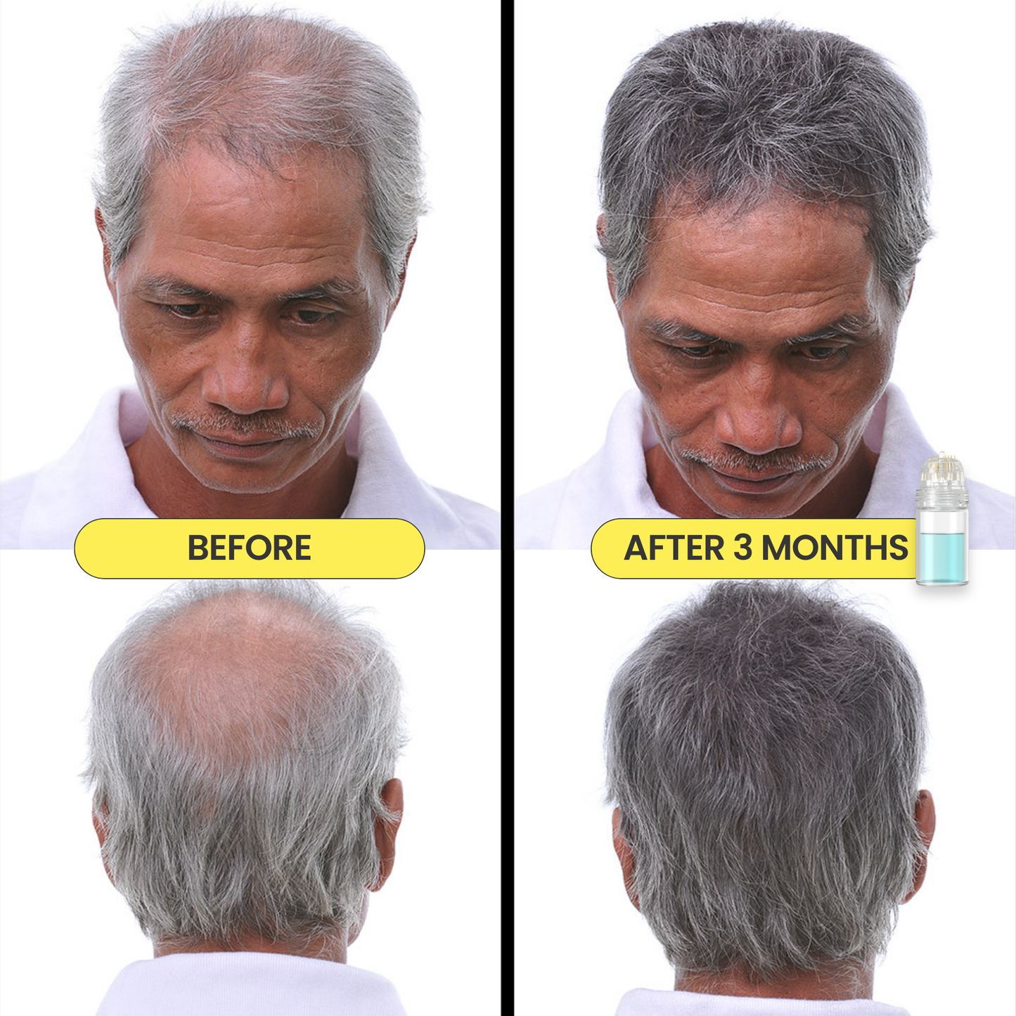 Mikro Re:Grow 30-Day Hair Regrowth System